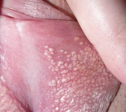 Удаление гранул Фордайса (себорейных кист) на половых губах у женщин